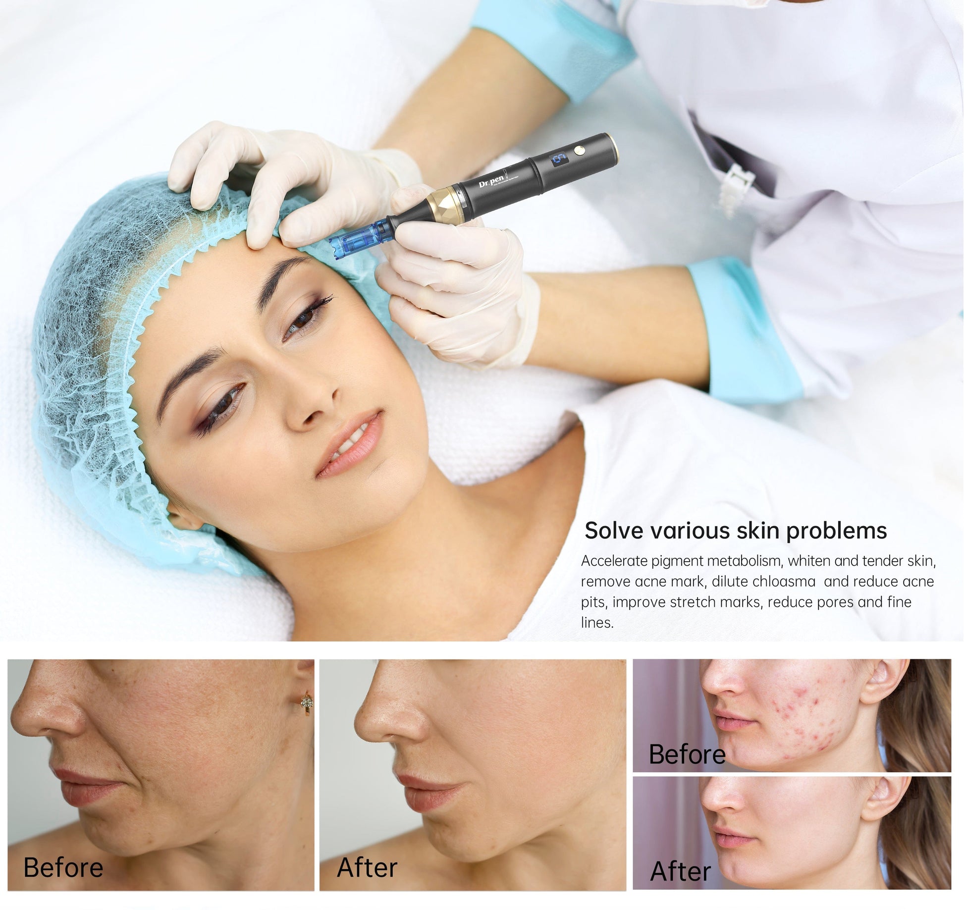 Sichuan Palace Dr. Pen A8S Ultima Pro Microneedling Pen